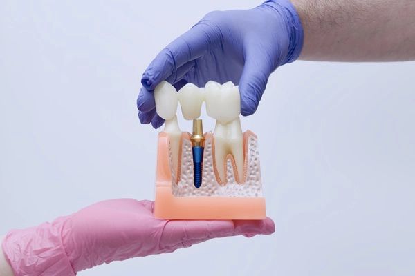 How Often To Replace A Dental Bridge And How To Extend Its Lifespan