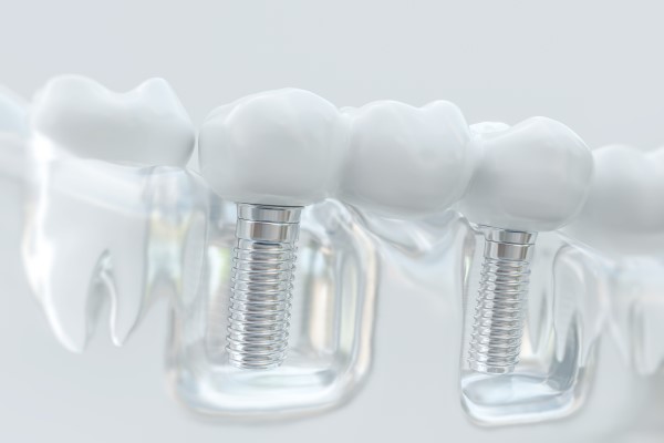 Dental Implants Aurora, CO
