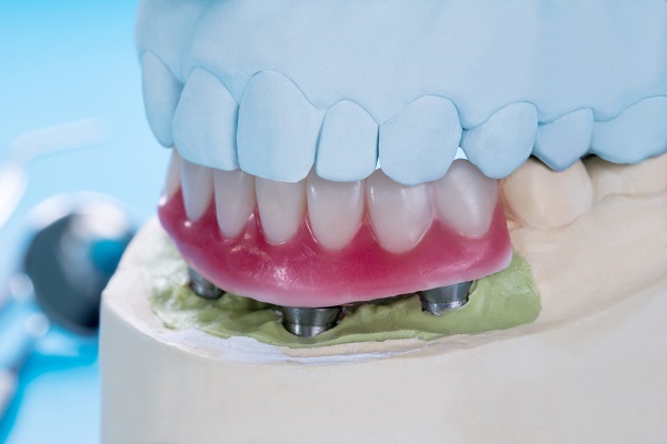 How Stable Are Implant Supported Dentures?