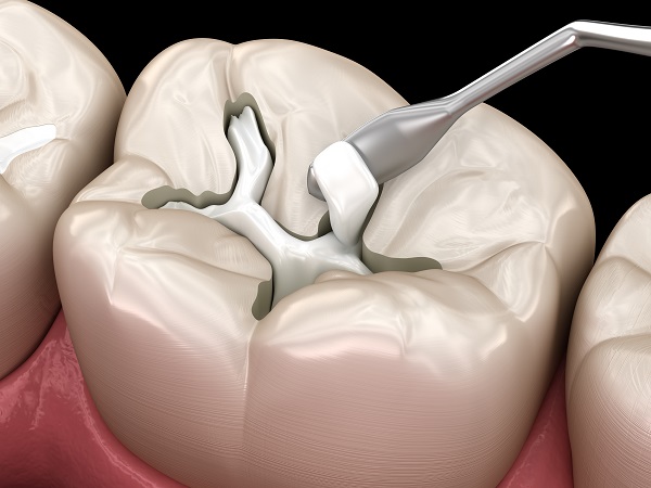 Types Of Tooth Fillings: When Are Each Recommended?