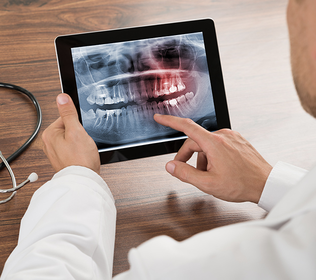 Aurora Types of Dental Root Fractures